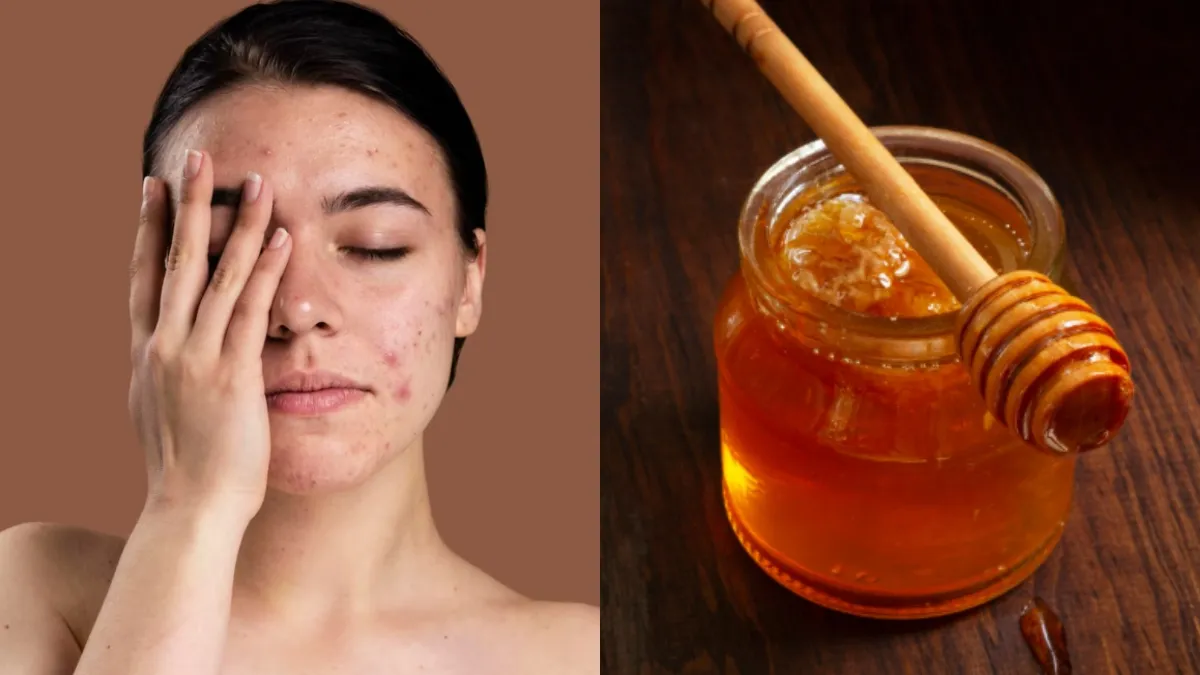 शहद में मिलाएं किचन में रखा भूरा मसाला, चेहरे पर हफ्ते में 2 बार लगाएं, मिल जाएगा मुहांसों से छुटकारा