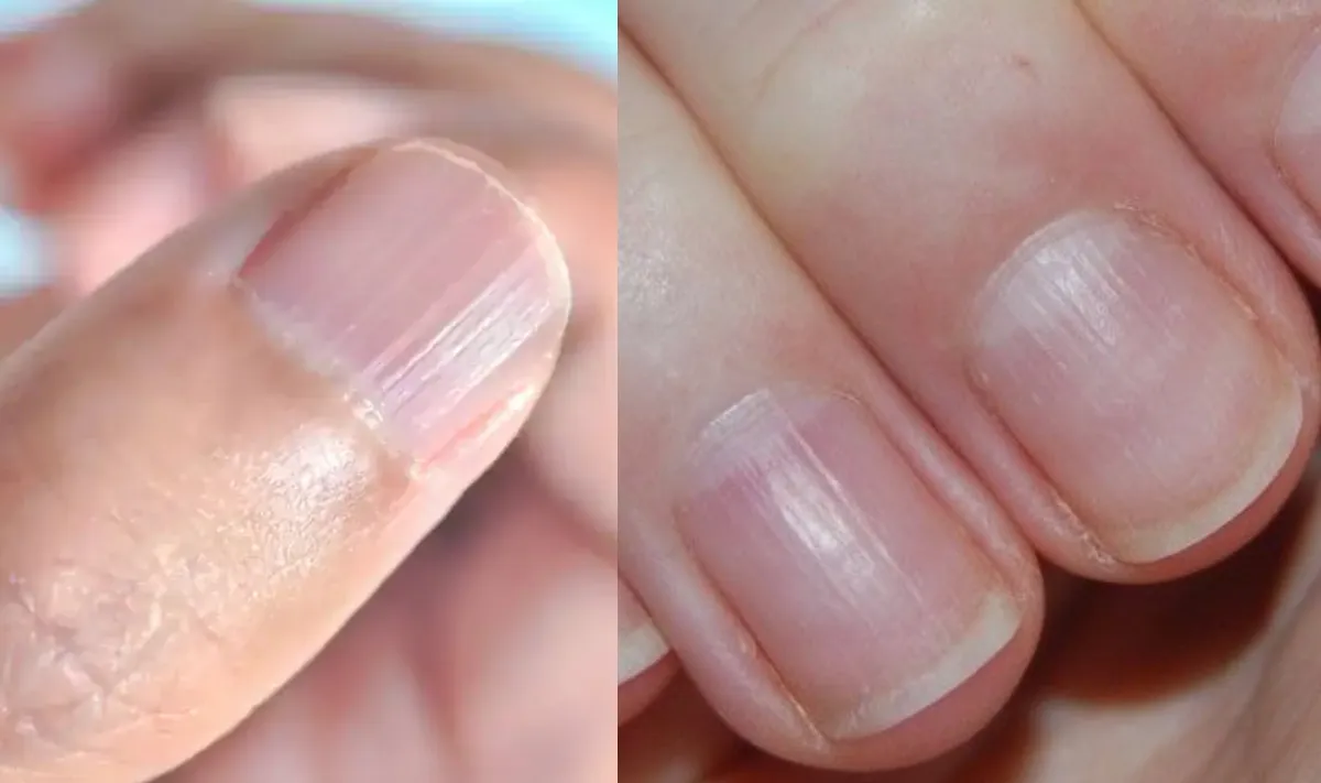 नाखून पर उभरी धारियां किस बात का संकेत है, क्यों बन जाती हैं लाइन, जानिए शरीर में किस कमी के कारण ऐसा होता है